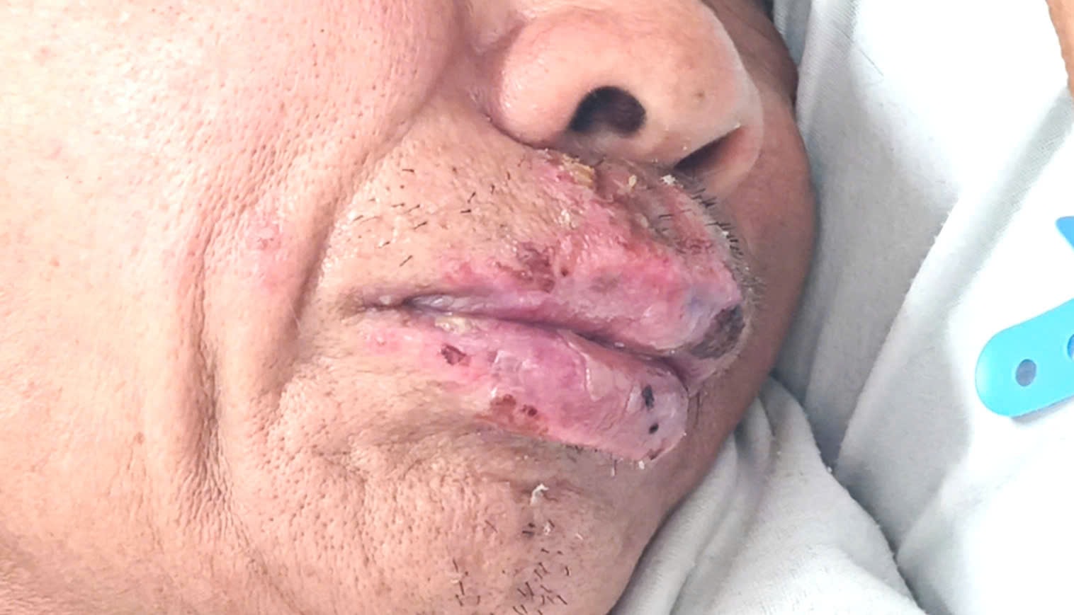 Người đàn ông ăn nem sống và tiết canh mắc liên cầu khuẩn lợn gây điếc