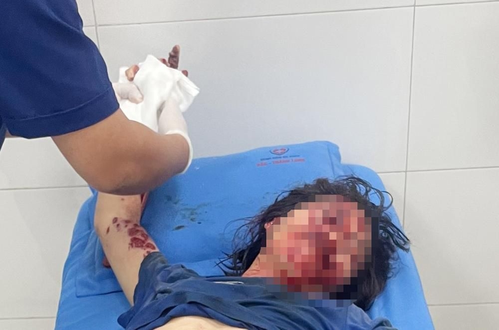 Bắc Giang: Điện thoại phát nổ khi sạc pin, một phụ nữ bị thương nặng
