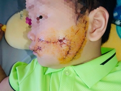 bac ninh be 5 tuoi bi cho can nat vung mat