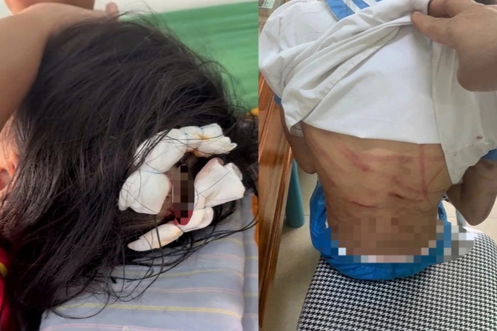 Hà Tĩnh: Công an làm việc với cha dượng nghi bạo hành bé gái lớp 5 với vết thương chằng chịt