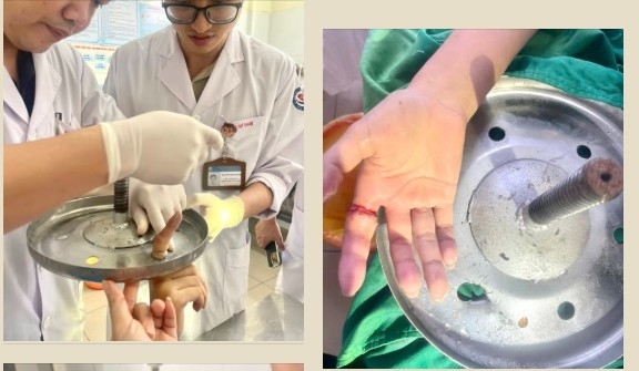 Nghịch dại, bé 12 tuổi ở Bắc Ninh suýt mất ngón tay vì mắc kẹt vào ghế xoay