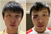 Du học sinh ở Anh bị đánh và kỳ thị vì virus corona