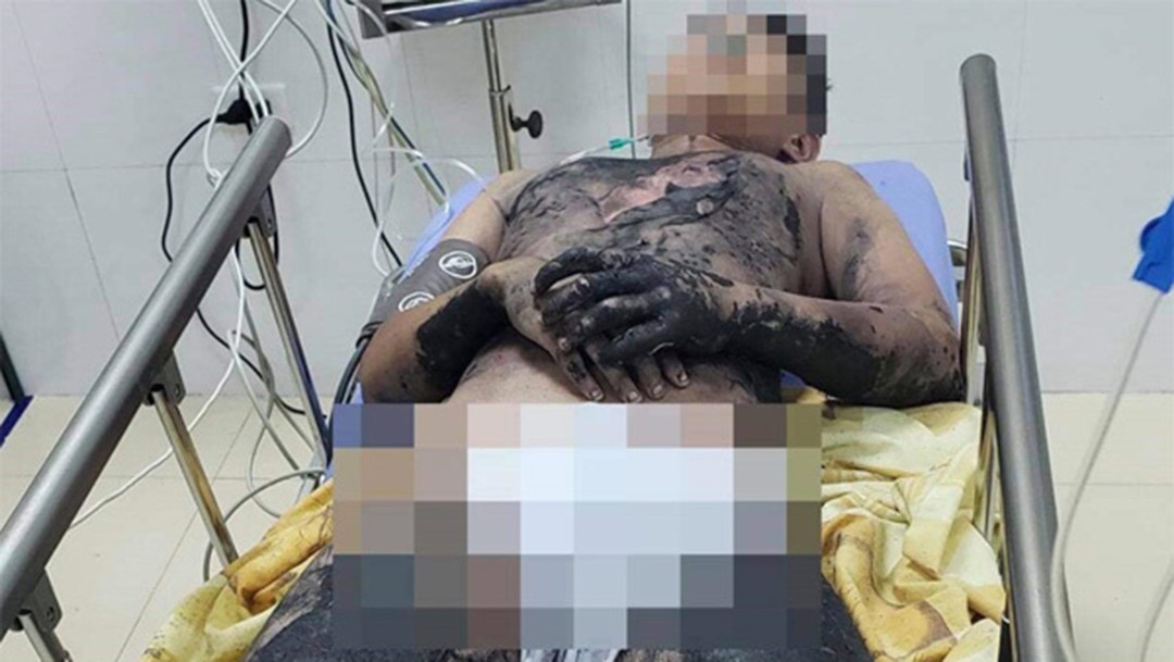 Làm thí nghiệm tại nhà, một nam sinh Quảng Ninh bị bỏng nặng