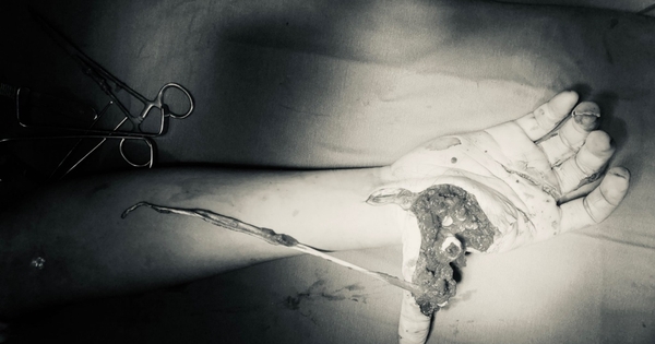 Thanh niên 16 tuổi dập nát bàn tay do pháo tự chế phát nổ