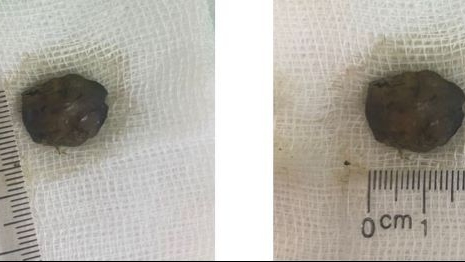 Ngậm kha tử trị ho dẫn đến hóc dị vật