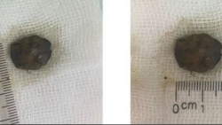 Ngậm kha tử trị ho dẫn đến hóc dị vật