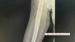 Hy hữu que tránh thai “đi lạc” trong cơ bắp tay