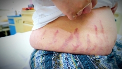 Suy tuyến thượng thận do lạm dụng thuốc xịt mũi chứa corticoid