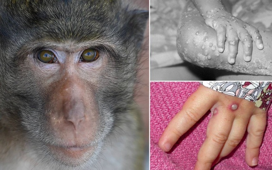 TP Hồ Chí Minh ghi nhận ca đậu mùa khỉ đầu tiên