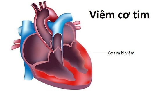 Bé gái nguy kịch vì viêm cơ tim tối cấp do thời tiết lạnh