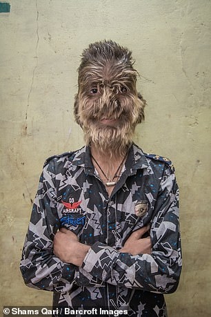 16 tre em bi hoa thanh nguoi soi vi ngo doc thuoc tri rung toc