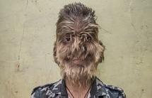 16 trẻ em bị hóa thành "người sói" vì ngộ độc thuốc trị rụng tóc