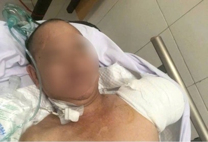 Cuộc chiến 47 ngày giành sự sống cho bệnh nhân nguy kịch ở Bệnh viện Bạch Mai