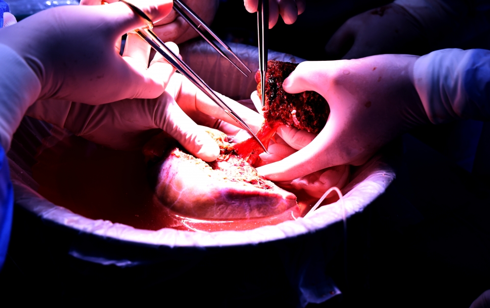 Đột phá y khoa: Chia gan từ người chết não để ghép cứu sống 2 ca bệnh hiểm nghèo