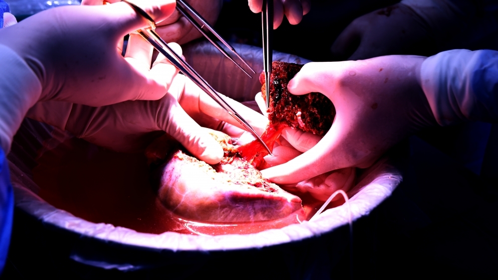 Đột phá y khoa: Chia gan từ người chết não để ghép cứu sống 2 ca bệnh hiểm nghèo