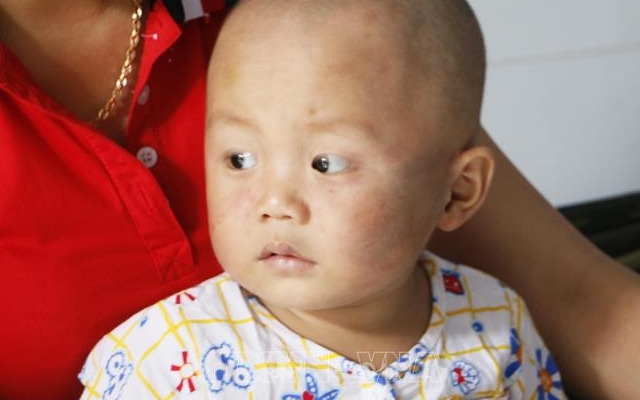 Bé trai bị chấn thương cho bảo mẫu tát liên tục vào mặt