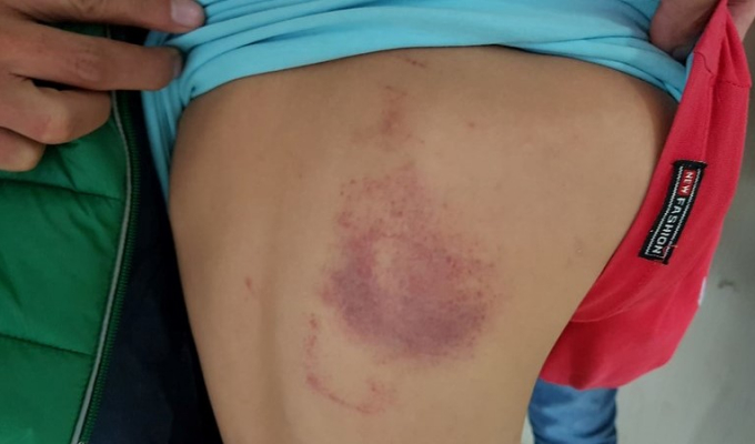 Đình chỉ công tác cô giáo chủ nhiệm đánh học sinh lớp 2 tím lưng