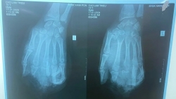 Nổ bình gas mini khi ăn lẩu, thiếu niên 15 tuổi bị dập nát tay