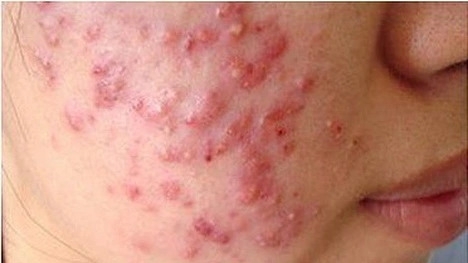 Làm đẹp cấp tốc đón Tết, hiểm hoạ khôn lường