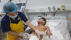 Dập nát tay, thủng bụng do đốt pháo