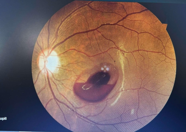 Hình ảnh xuất huyết hoàng điểm của bệnh nhân bị tia laser chiếu vào mắt (Ảnh: BVCC)