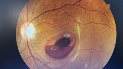 them mot truong hop bi mat thi luc do tia laser chieu vao mat