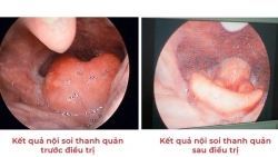 Người phụ nữ suýt chết vì chữa hóc xương cá theo mẹo dân gian