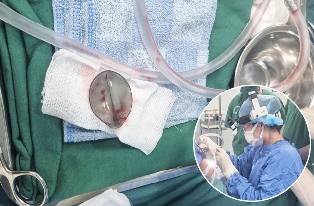 Dị vật là phần đầu muỗng nhựa bị gãy