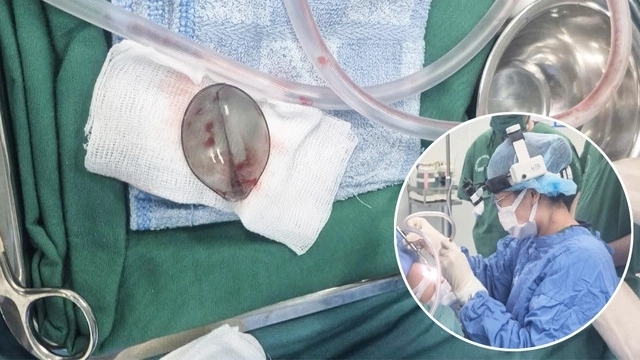 Bé trai 4 tuổi bị mắc thìa nhựa ở đường thở