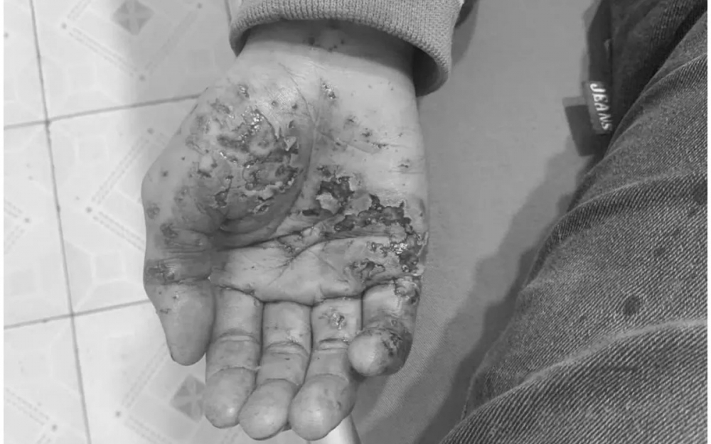 Bệnh nhân nhập viện trong tình trạng bỏng và chấn thương vùng mặt, tay, chân do điện thoại phát nổ khi vừa sạc vừa sử dụng.