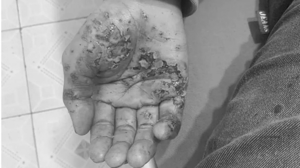 Bỏng nặng do điện thoại phát nổ khi vừa sạc vừa sử dụng