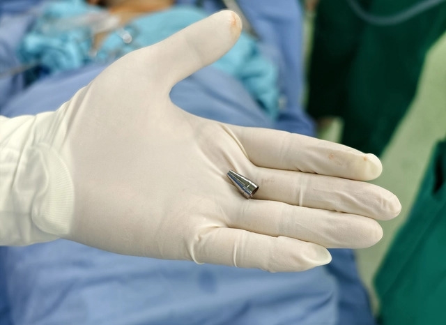 Đầu ngòi bút được lấy ra khỏi phế quản của bệnh nhi