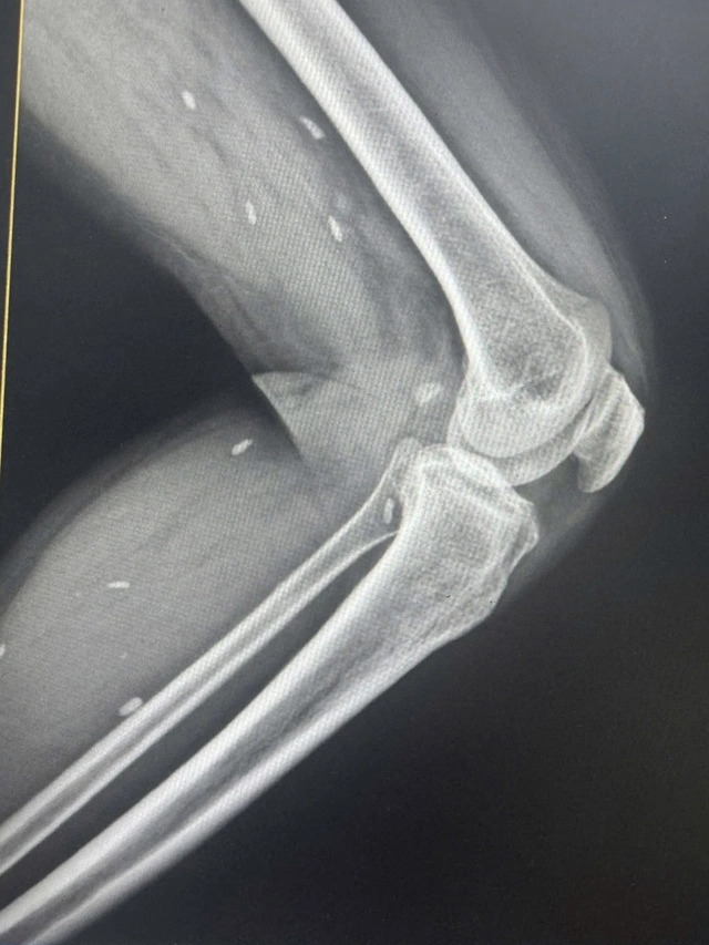 chụp X- quang, bác sĩ phát hiện các mô vùng xương đùi và cẳng chân bệnh nhân có nhiều kén sán kích thước như hạt gạo