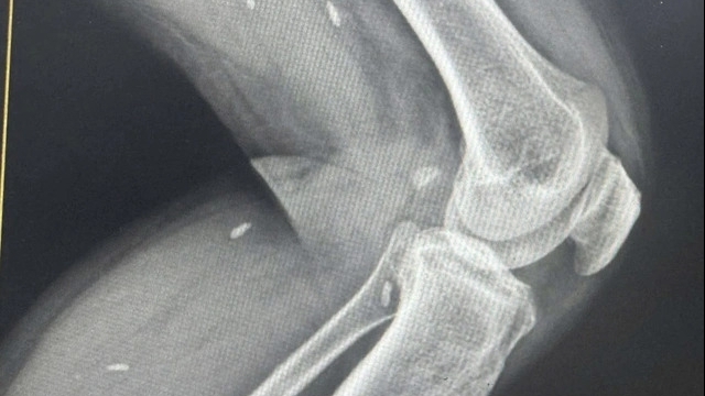 Phát hiện nhiều kén sán trong chân bệnh nhân