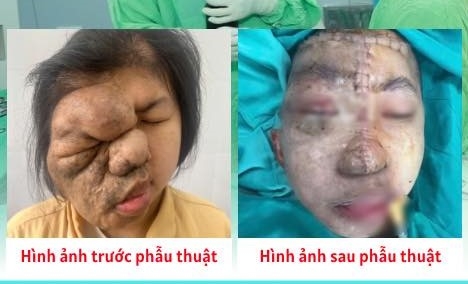 Phẫu thuật tái tạo gương mặt cho cô gái trẻ mang khối u suốt 17 năm