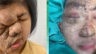 Phẫu thuật tái tạo gương mặt cho cô gái trẻ mang khối u suốt 17 năm