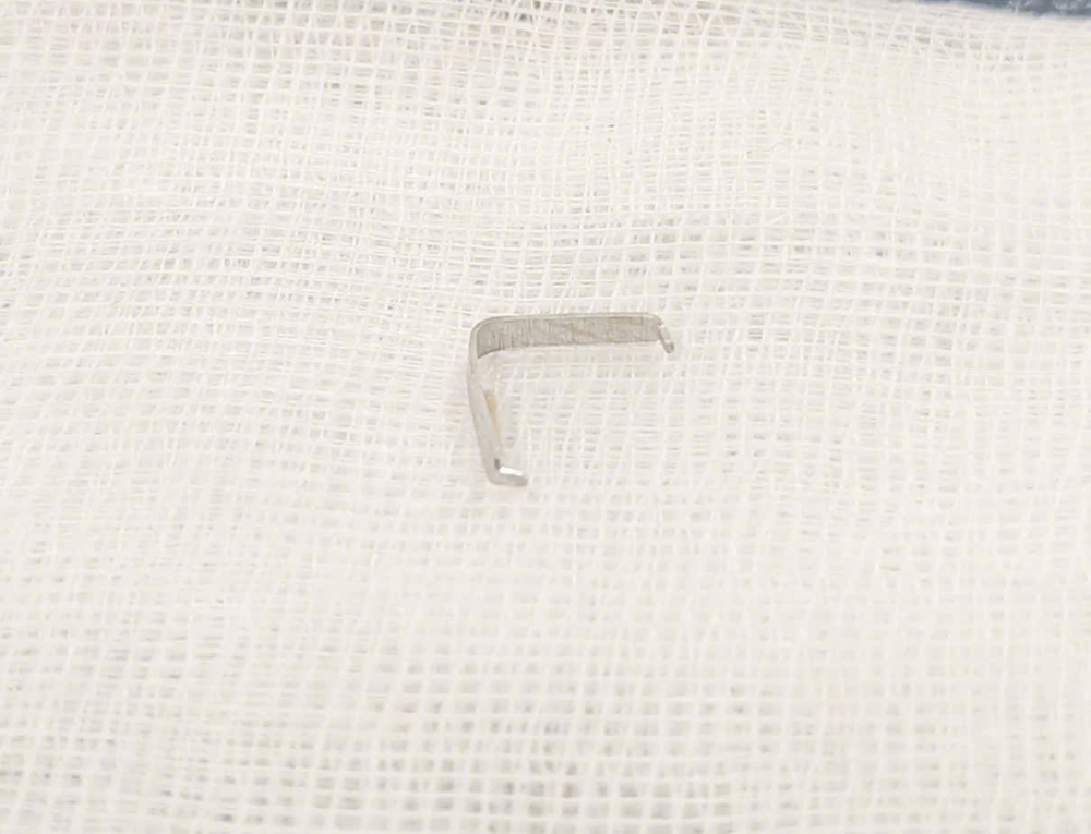 Bác sĩ đã tiến hành gặp dị vật là một chiếc ghim tất bằng kim loại có hai đầu nhọn. được gắp ra