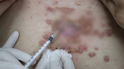 canh bao nguy co ap xe sau tiem chat lam day