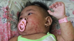 Số ca mắc bệnh sởi trên toàn cầu tăng tới 79% trong năm 2023