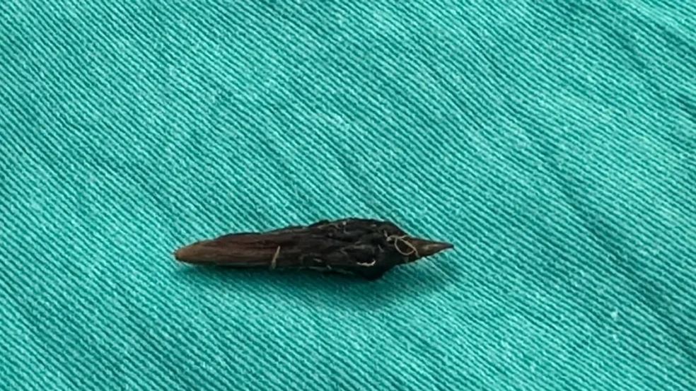 Vô tình nuốt hạt táo đỏ, người phụ nữ bị thủng ruột