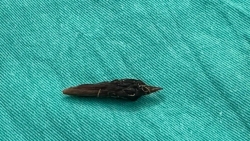 Vô tình nuốt hạt táo đỏ, người phụ nữ bị thủng ruột