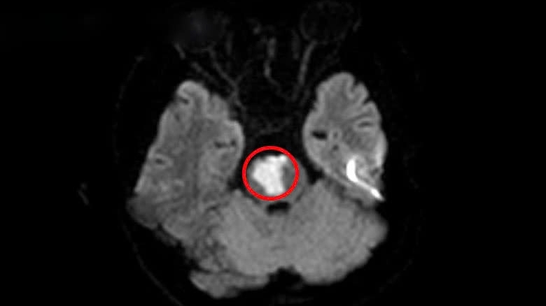 Nam thanh niên 17 tuổi bị đột quỵ