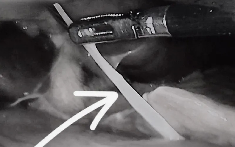 Hình ảnh xương cá trong dạ dày bệnh nhân