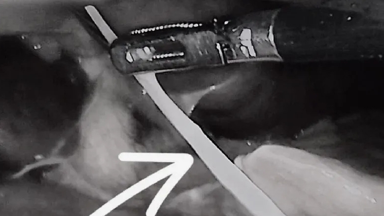 Thủng dạ dày vì nuốt mảnh xương cá