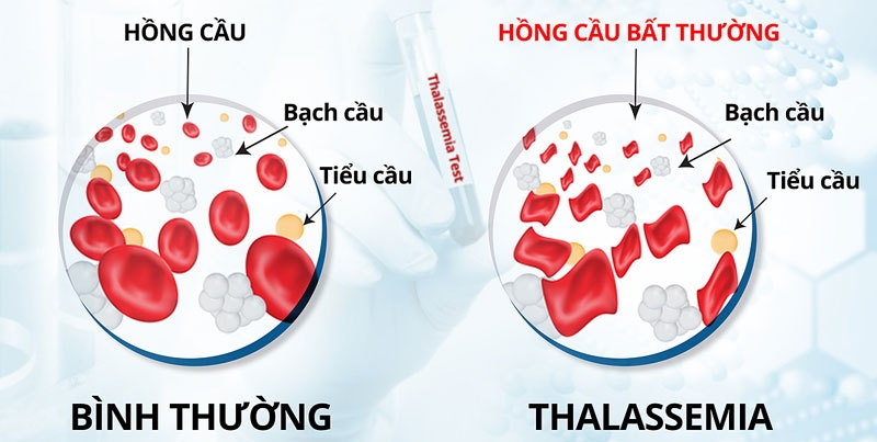 Mỗi năm tại Việt Nam có thêm khoảng 8.000 trẻ em sinh ra bị bệnh thalassemia, trong đó có khoảng 2.000 trẻ bị bệnh mức độ nặng và khoảng 800 trẻ không thể ra đời do phù thai