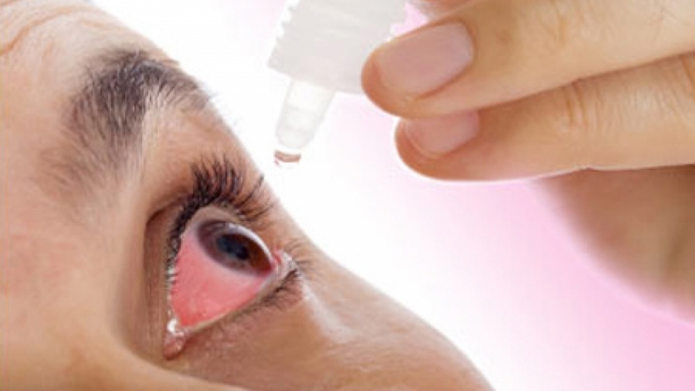 Tự ý sử dụng thuốc nhỏ mắt chứa corticoid kéo dài gây biến chứng nguy hiểm