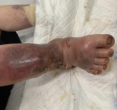 Hình ảnh da bàn chân rất mỏng, dẫn đến rách da, nhiễm trùng bàn chân nặng của bệnh nhân. Ảnh: BVCC