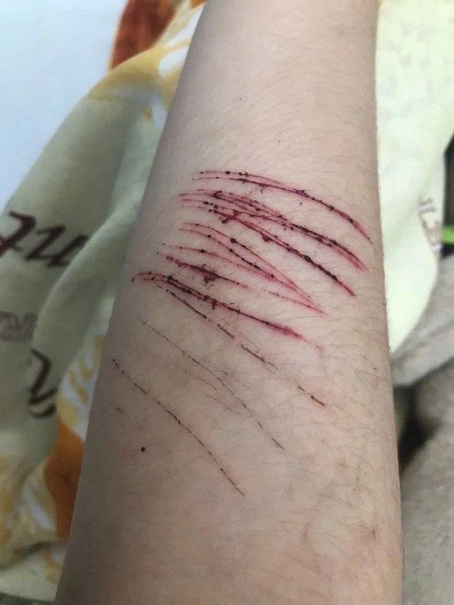 Theo các bác sĩ, hành vi tự gây ra những tổn thương trên cơ thể có thể gặp ở mọi lứa tuổi, thường xuất hiện ở lứa tuổi vị thành niên và gặp ở nữ nhiều hơn nam Theo các bác sĩ, hành vi tự gây ra những tổn thương trên cơ thể có thể gặp ở mọi lứa tuổi, thường xuất hiện ở lứa tuổi vị thành niên và gặp ở nữ nhiều hơn nam