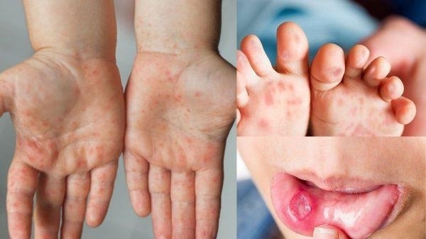 Gia tăng các ca bệnh truyền nhiễm