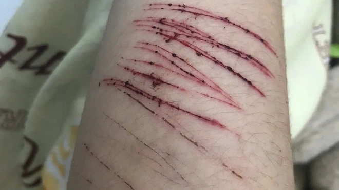 Nữ sinh 15 tuổi tự rạch tay để giải toả áp lực